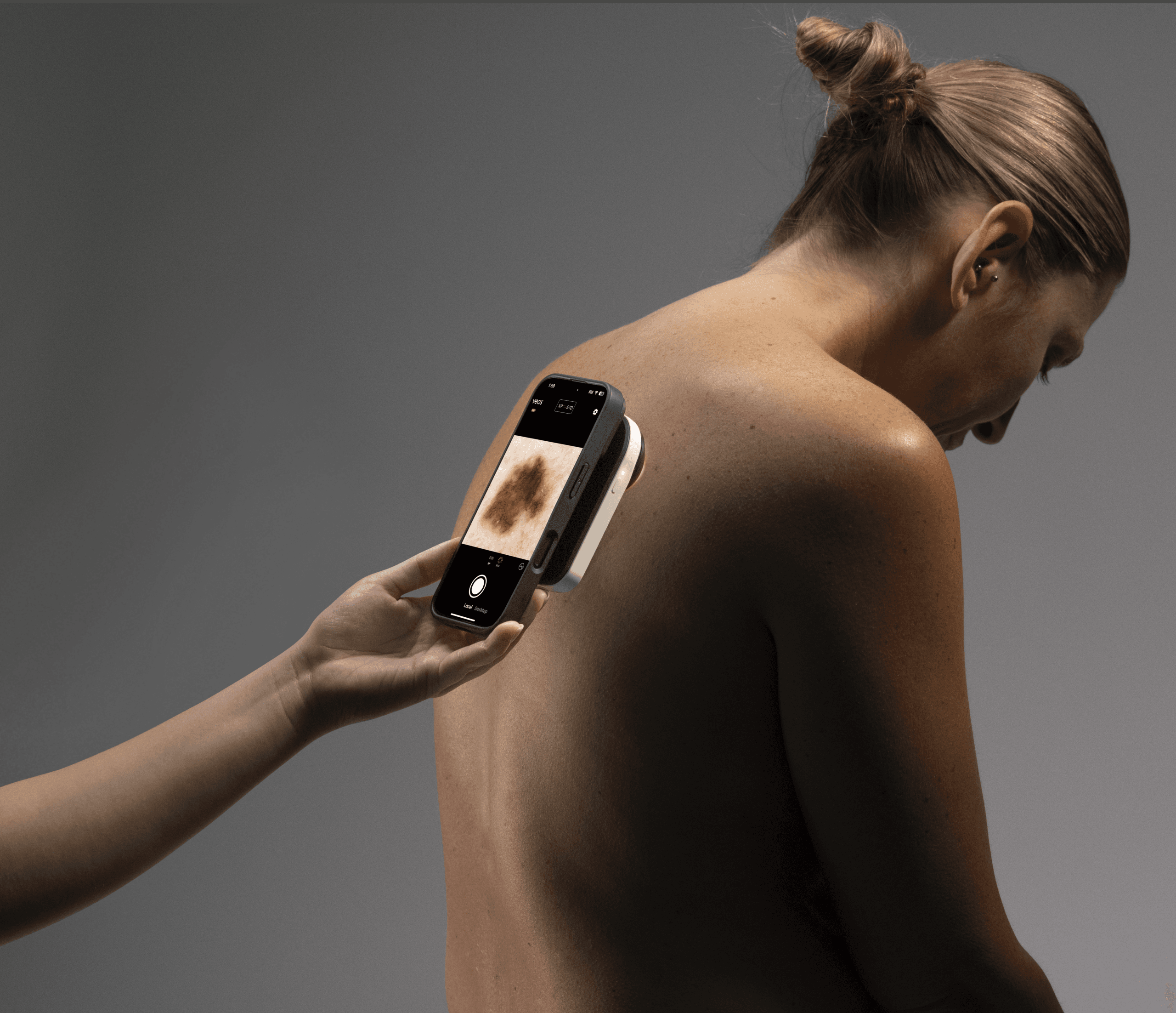 VEOS handheld skin imaging device examining a patient's shoulder for skin lesions.